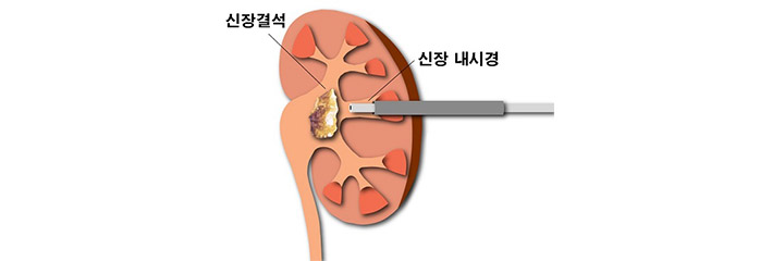 치료 방법 및 주의사항