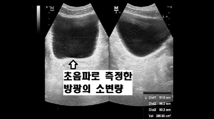 진단 방법